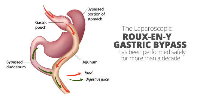 roux en y gastric bypass anatomy