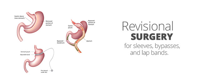 sleeve gastrectomy, Aloha Surgery