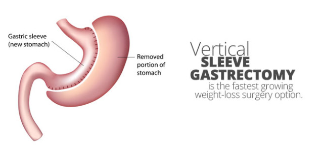 Laparoscopic Vertical Sleeve Gastrectomy | Aloha Surgery | Weight Loss ...