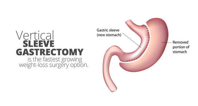 Better Long-Term Diabetes Outcomes w/ Sleeve Gastrectomy vs Medical Management