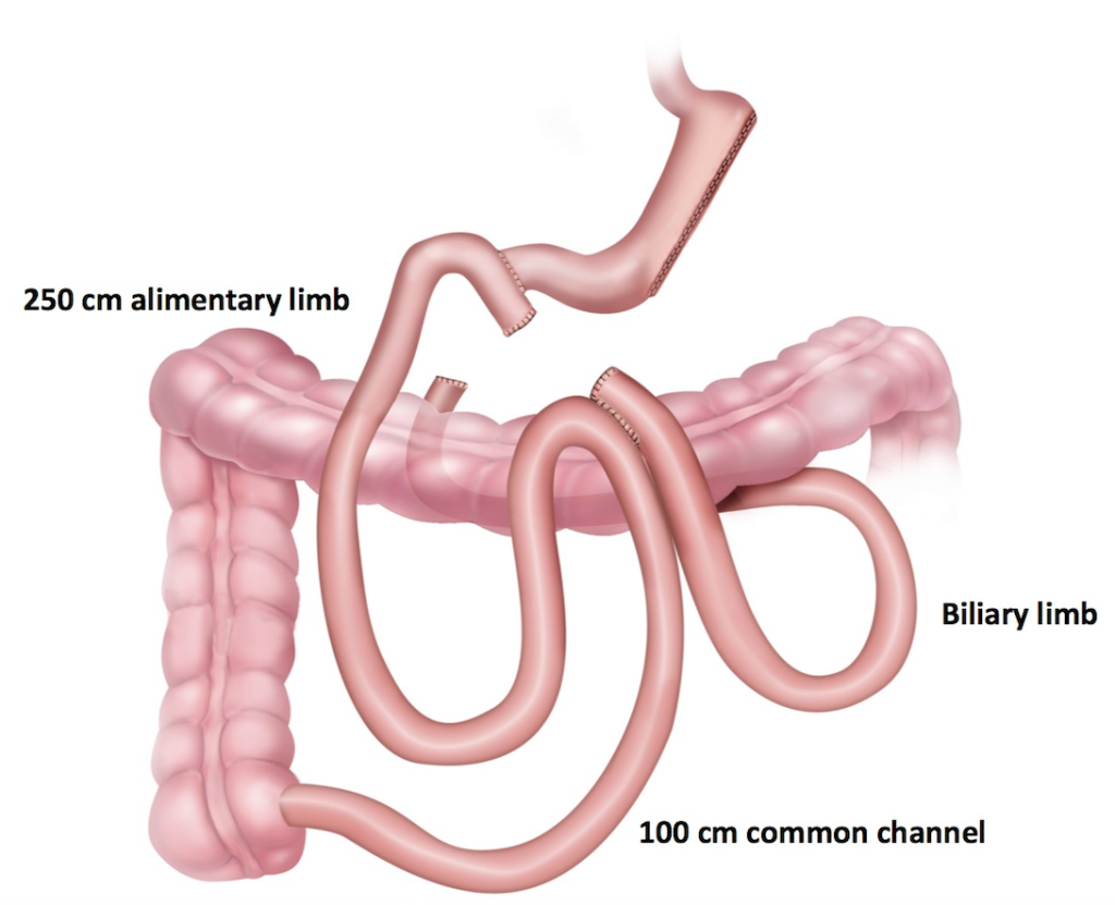 Duodenal Switch Surgery Aloha Surgery Weight Loss Surgery