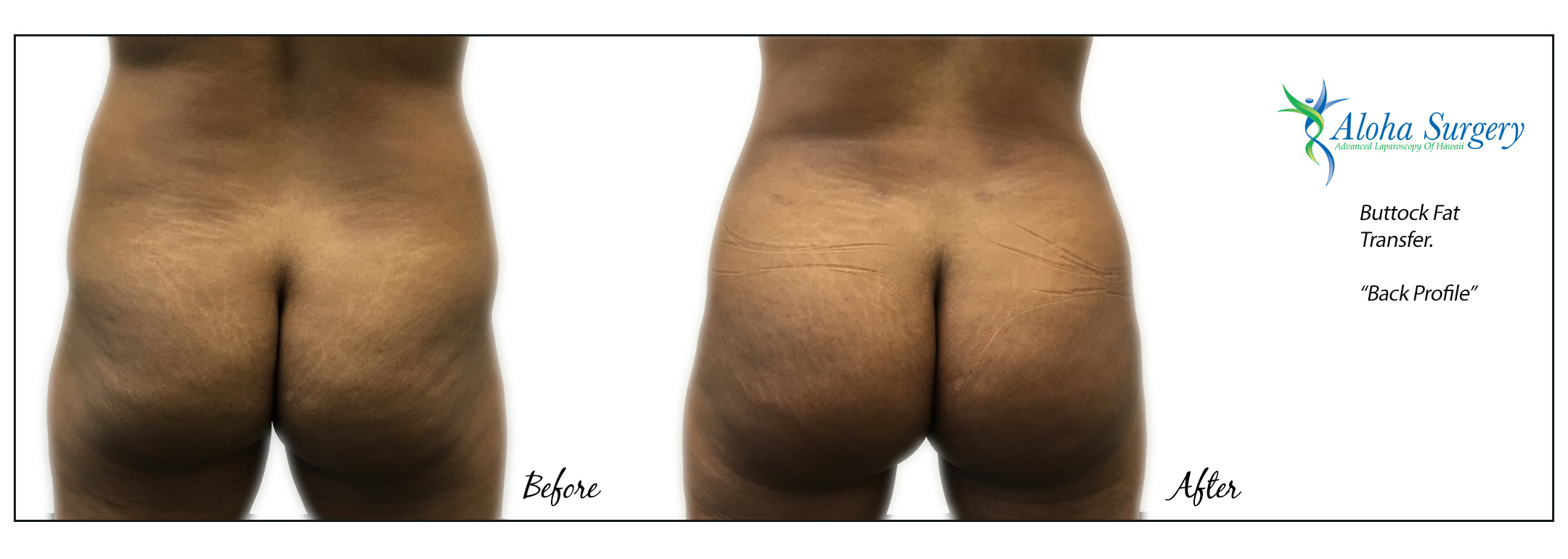 Aloha Surgery Buttock Fat Transfer