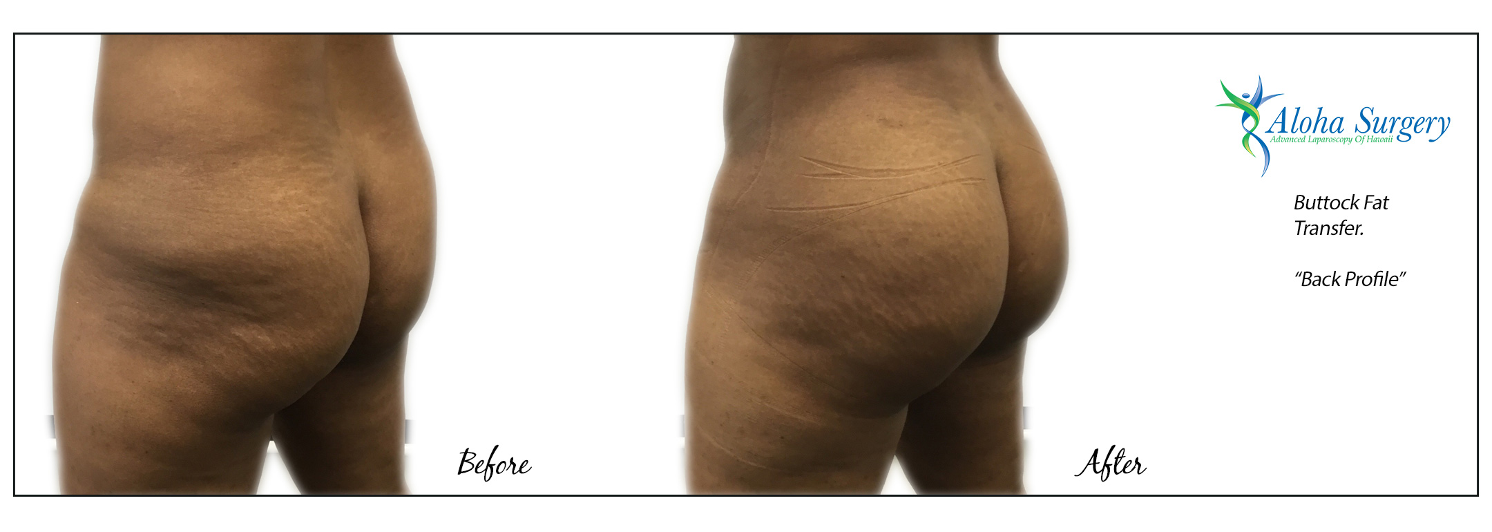 Aloha Surgery Buttock Fat Transfer