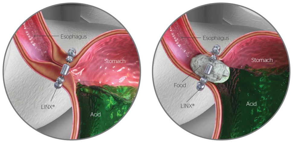 Dr. Fowler Now Doing The LINX Procedure For Reflux Disease | Aloha ...